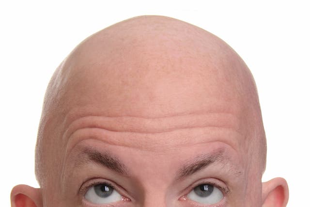 Thinning hair? Blame your genes