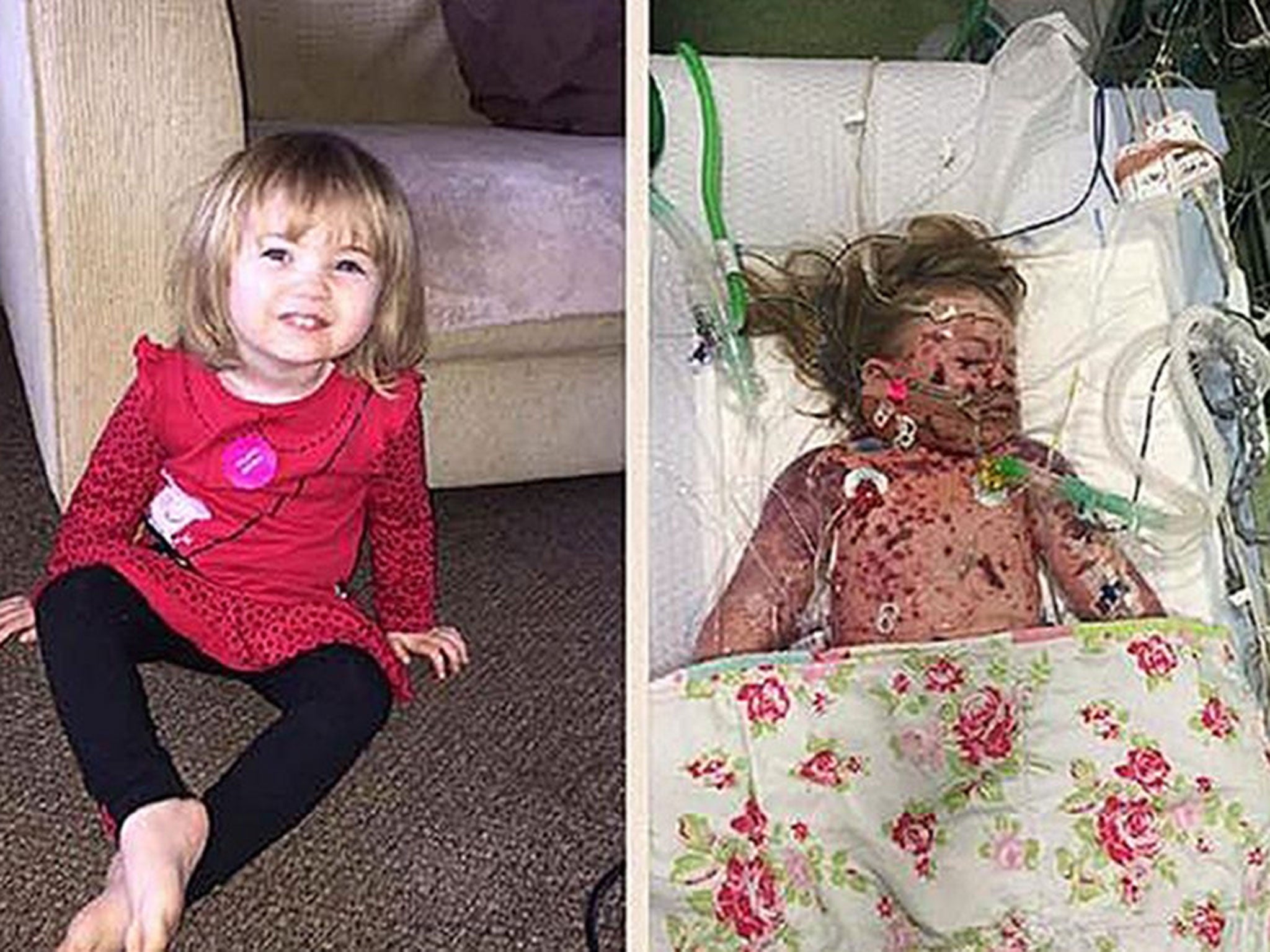 Faye Burdett before (left) and after she contracted meningitis, as almost 250,000 people have signed a petition calling for all children to be given a meningitis vaccine following the death of the two-year-old.