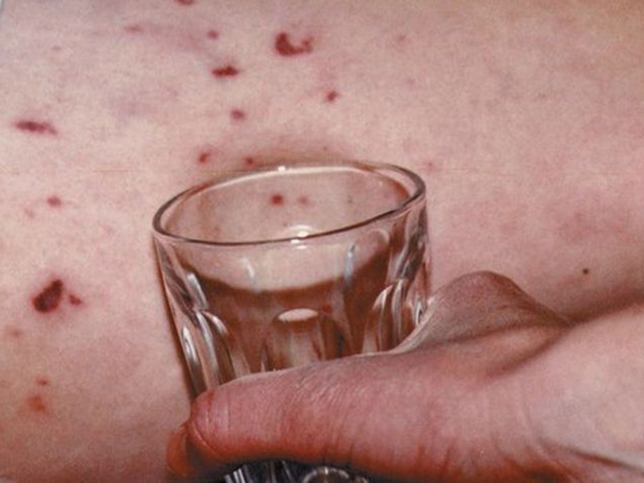 A rash that does not fade when pressed against a glass is a symptom of meningitis