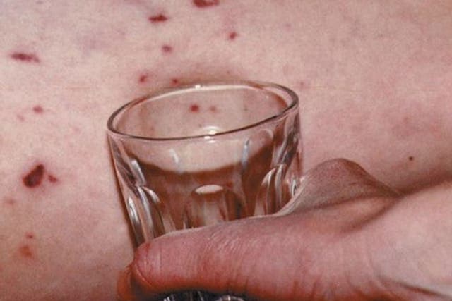 A rash that does not fade when pressed against a glass is a symptom of meningitis 