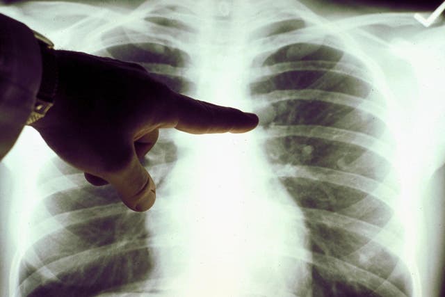 Non-smokers with lung cancer are 'disadvantaged'