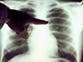 Machine that keeps lungs alive outside the body set for NHS use