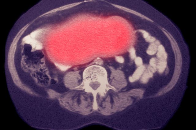Experts tell Katie Grant that diagnosing ovarian cancer early is key  – and recognising the symptoms is the first step to recovery.