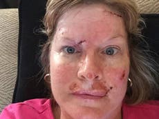 Woman shares shocking selfies of skin cancer surgery in warning