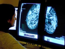 Woman shares breast photo in cancer symptoms warning