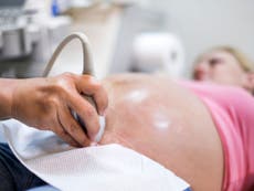 Norway allows foreign women pregnant with twins to abort healthy twins