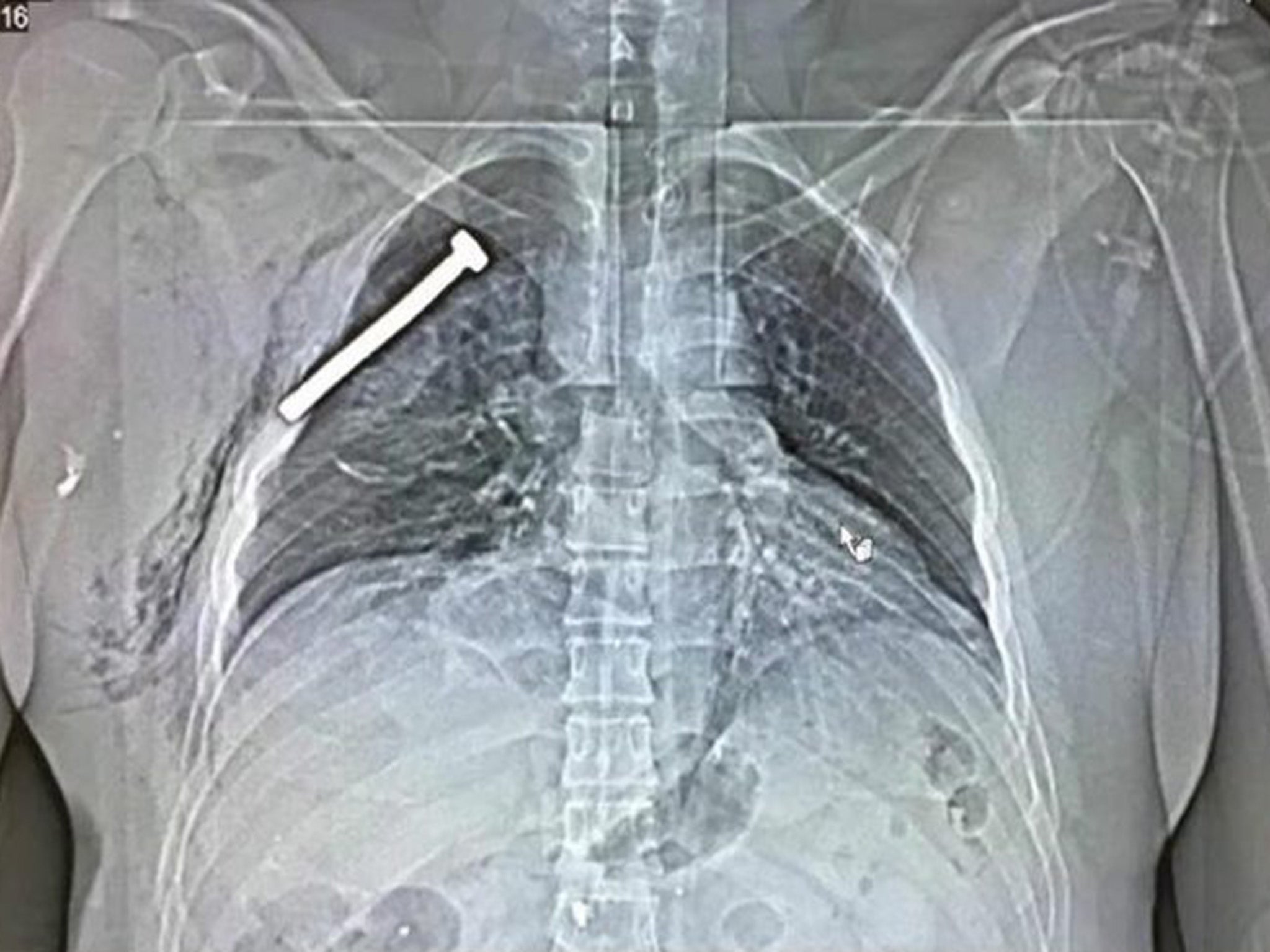 X-ray from victim of Brussels attacks shows a nail embedded in their chest