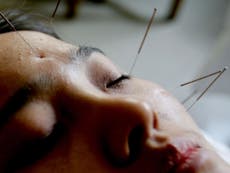 Acupuncture for back pain no more effective than 'sham treatment'