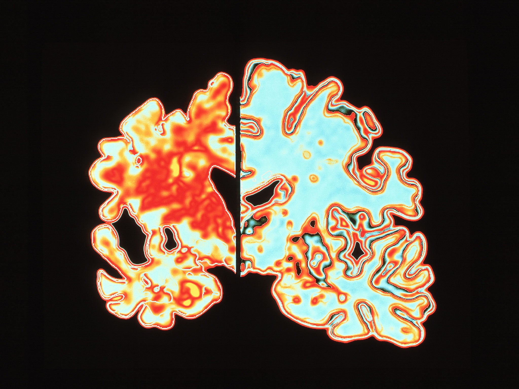 A computer graphic of a vertical (coronal) slice through the brain of an Alzheimer patient, left, compared with a normal brain, right