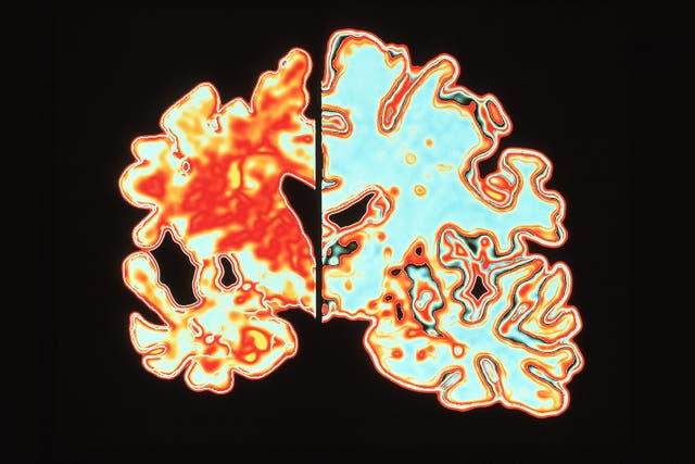 A computer graphic of a vertical (coronal) slice through the brain of an Alzheimer patient, left, compared with a normal brain, right