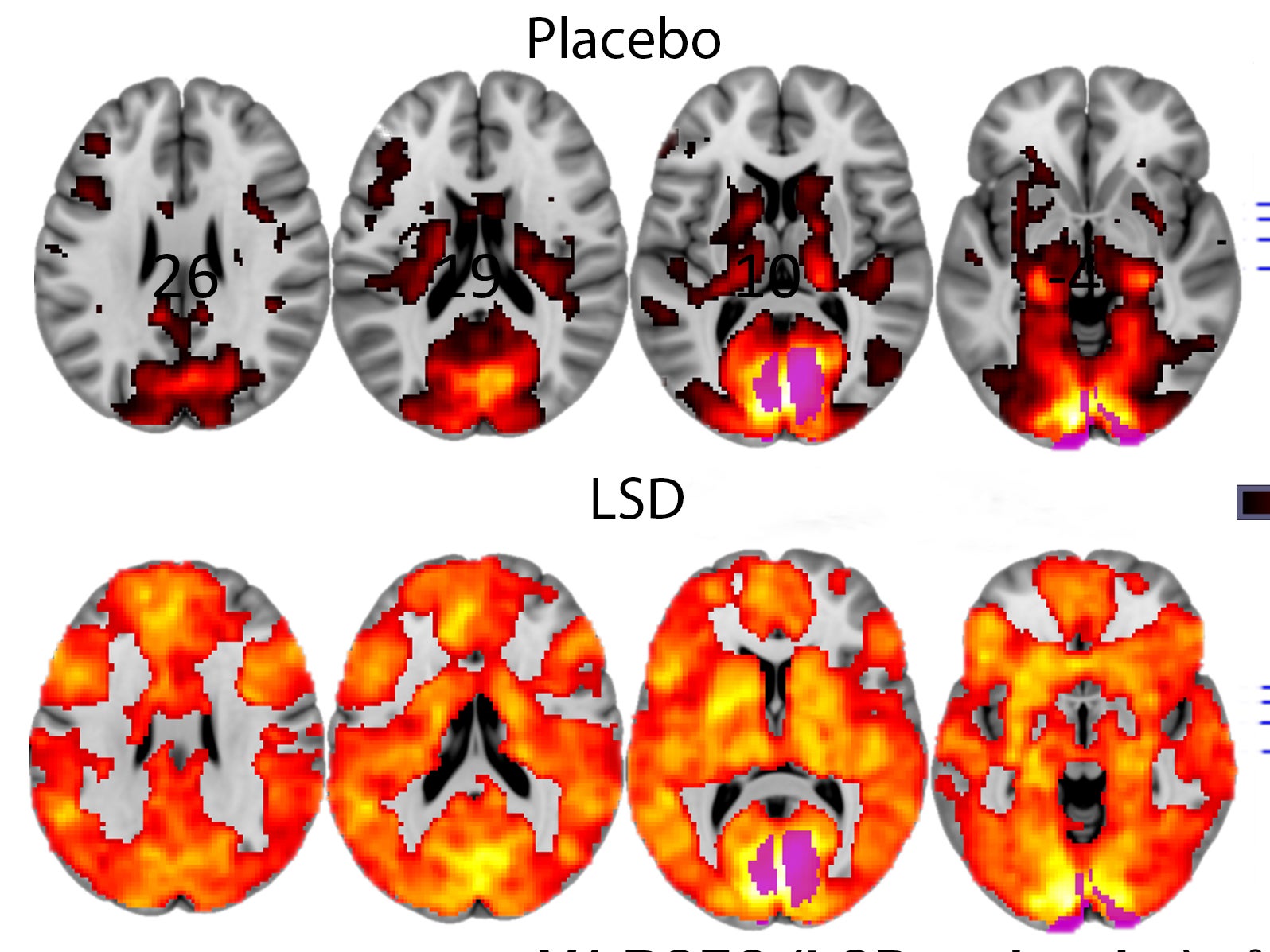 Brain scans showing the effect on LSD on people's brains from a study earlier this year