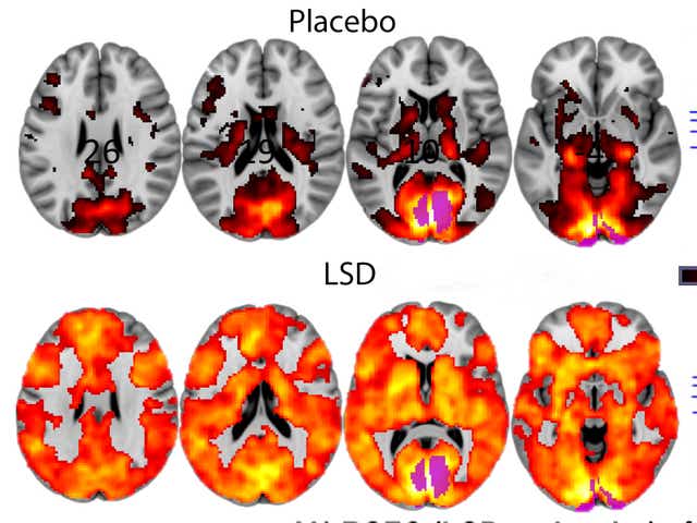 Brain scans showing the effect on LSD on people's brains from a study earlier this year
