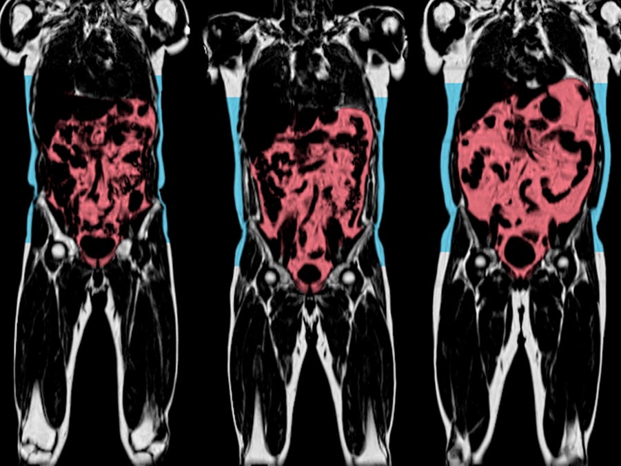 Three-dimensional scans show the levels of internal body fat in different individuals