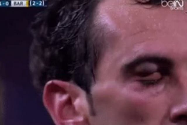 Diego Godin's eye after the Luis Suarez clash