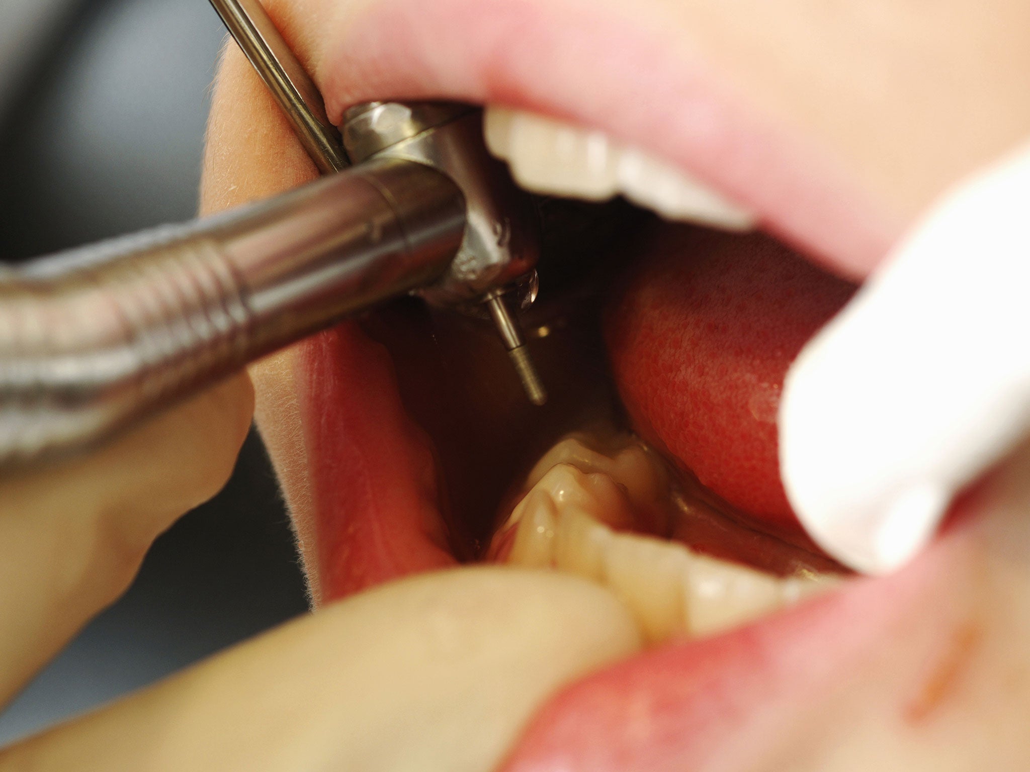 The British Dental Association (BDA) has accused the Government of commissioning only enough dentistry to treat about half the adult population
