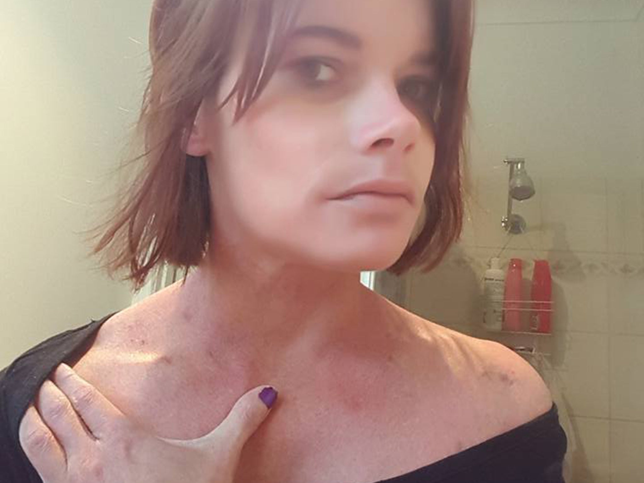 Photos show bruising on Ms Berry's collar bone, as well has her arms, thighs and breasts