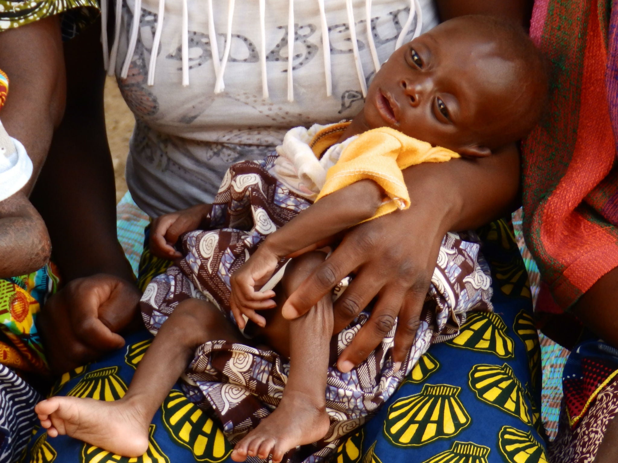 A child undergoing treatment for severe acute malnutrition at Kita Hospital, Kita, Mali on 14 March 2016