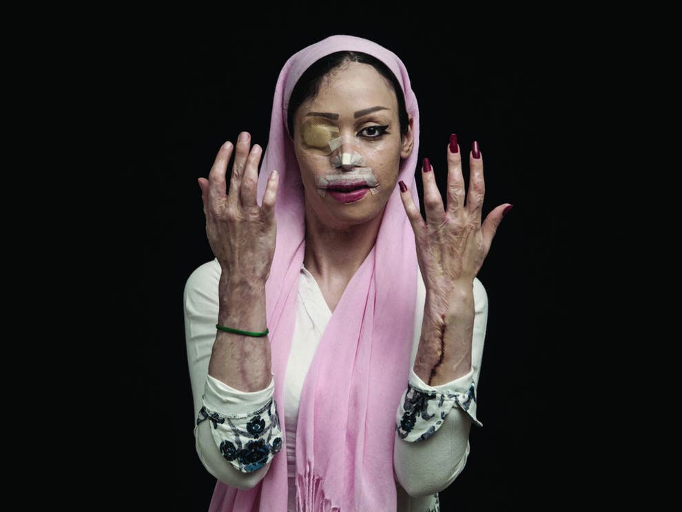 Acid Attack Victims Need Equality To Help Stop Violence 