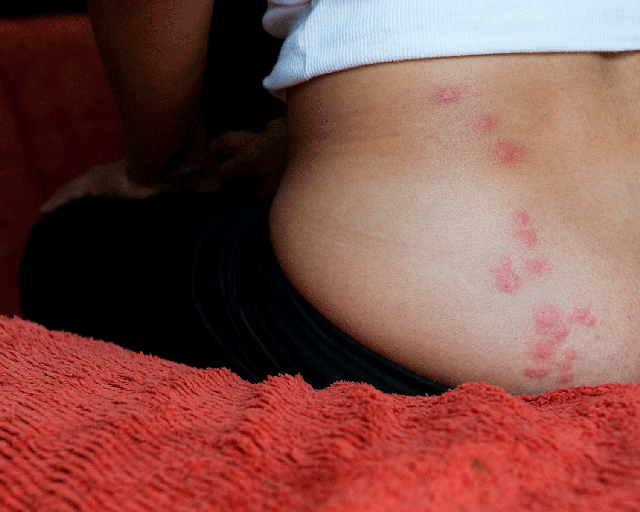 9 Symptoms And Signs Of Bed Bugs Terminix