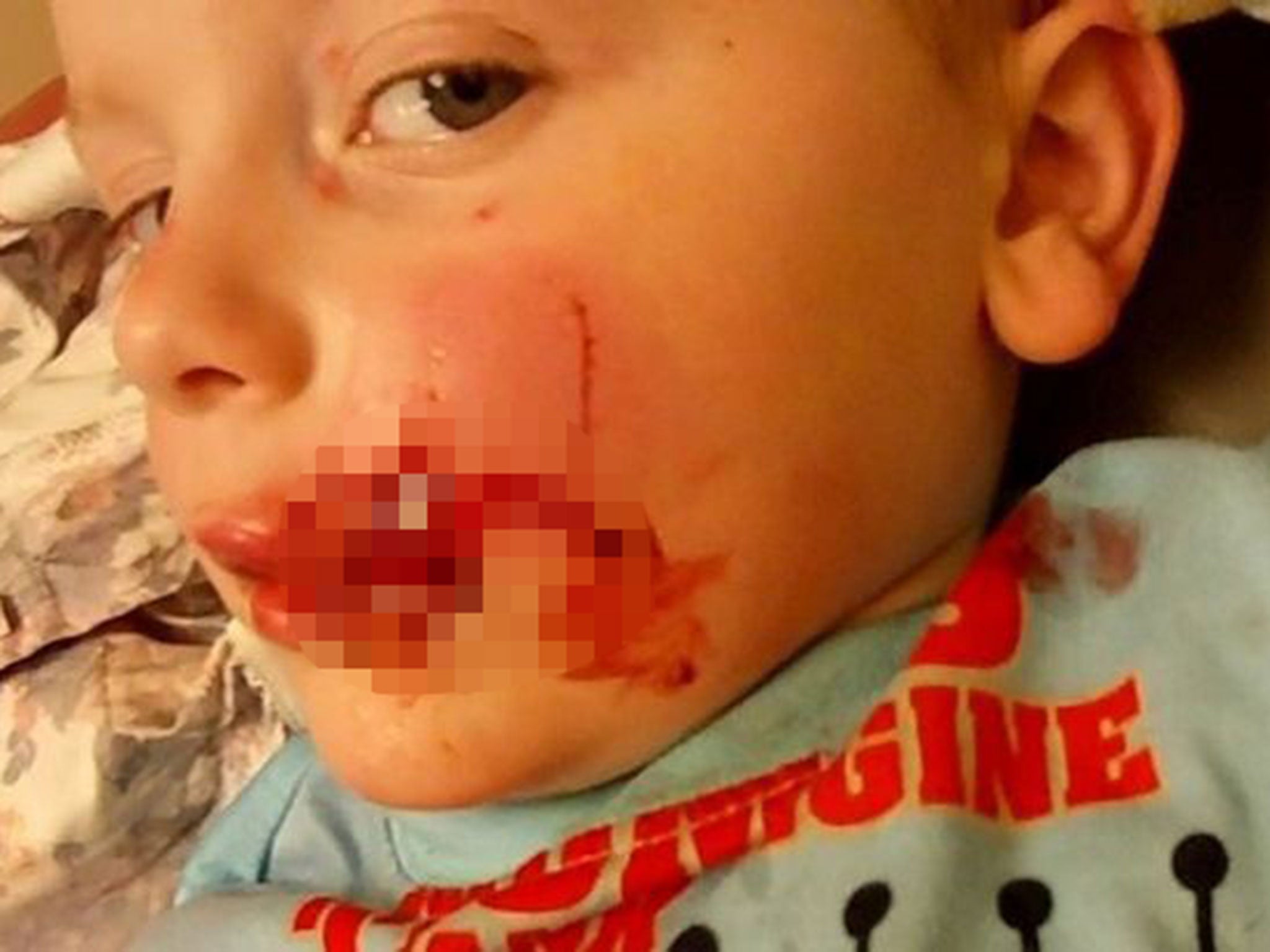 The boy's family released the pictures to warn others of the danger of dog attacks and help police track down the animal