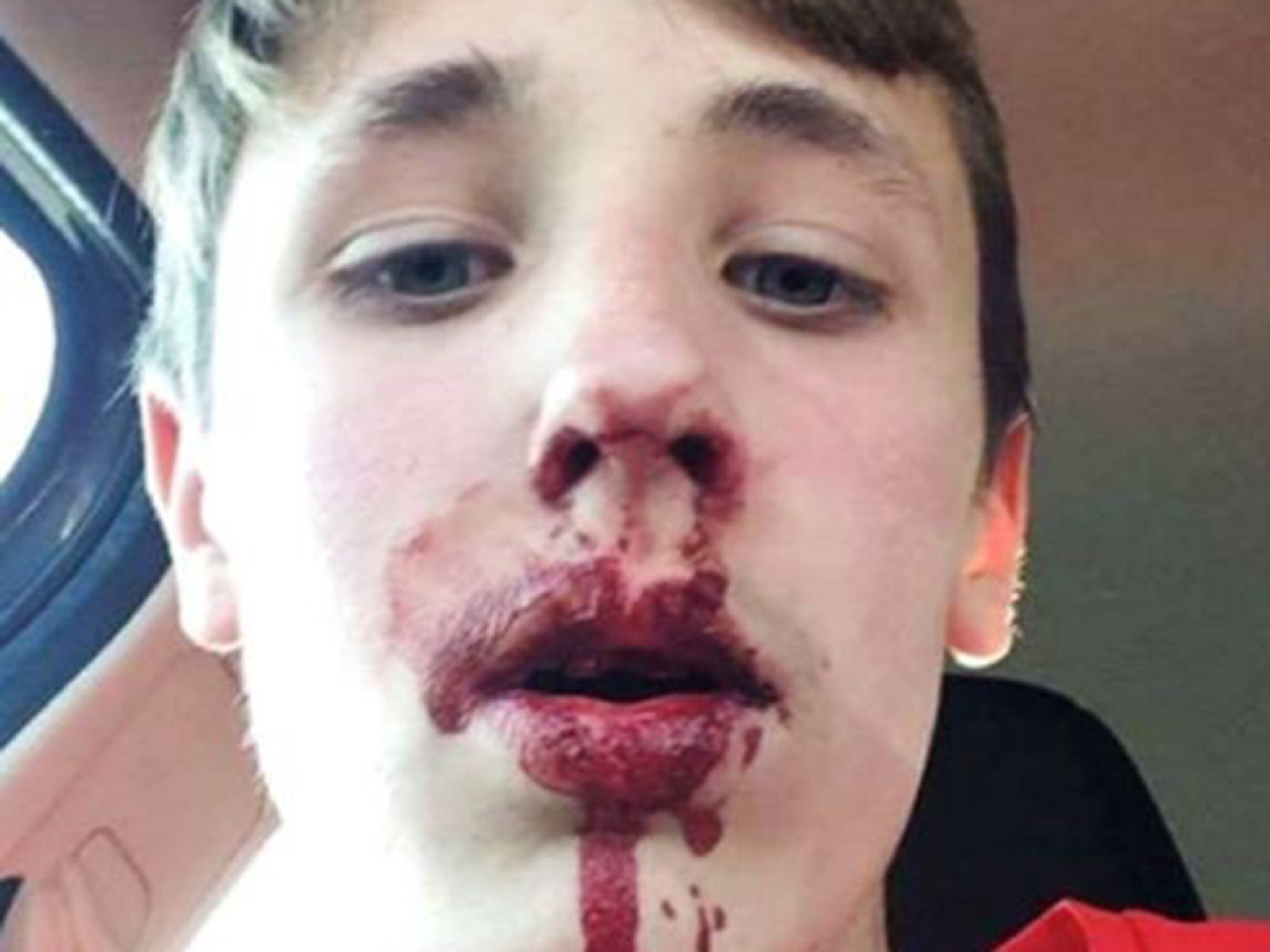 12-year-old Emerson Butler suffered a bloody nose and mouth after being punched by the Man City fan