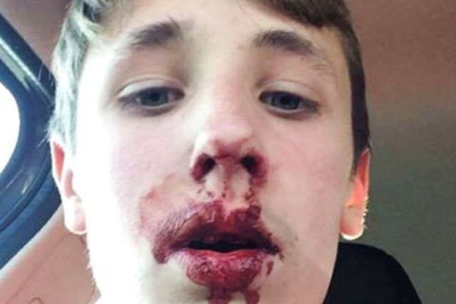 12-year-old Emerson Butler suffered a bloody nose and mouth after being punched by the Man City fan