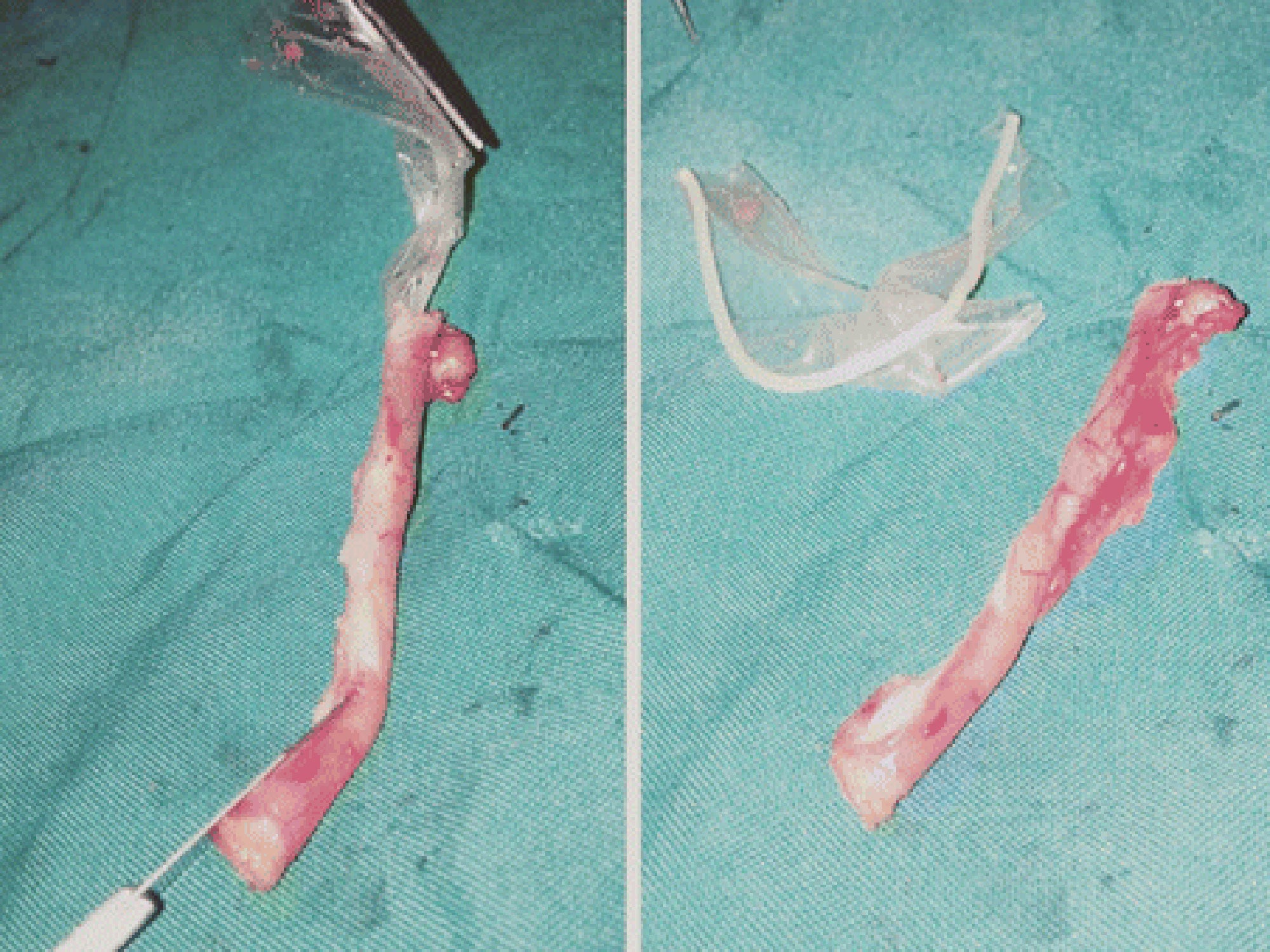 The condom was found inside the appendix after dissection