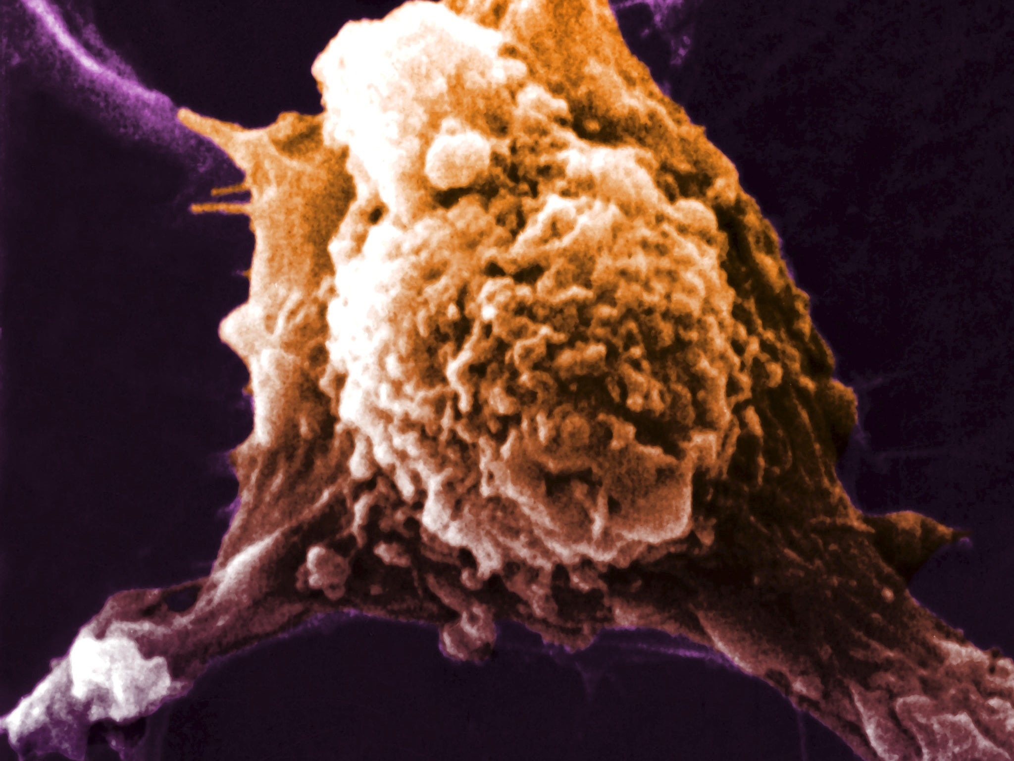 Scanning electron micrograph (SEM) of a cancerous cell showing pseudopodia ( pseudopod ). Generated by a protein named autocrine motility factor (AMF) enabling them to migrate to other parts of the body. Locomotion is integral to the entire process of metastasis.
2007