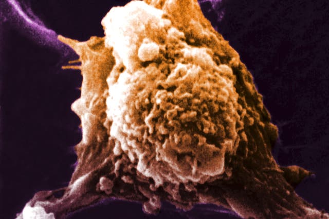 Scanning electron micrograph (SEM) of a cancerous cell showing pseudopodia ( pseudopod ). Generated by a protein named autocrine motility factor (AMF) enabling them to migrate to other parts of the body. Locomotion is integral to the entire process of metastasis.
2007