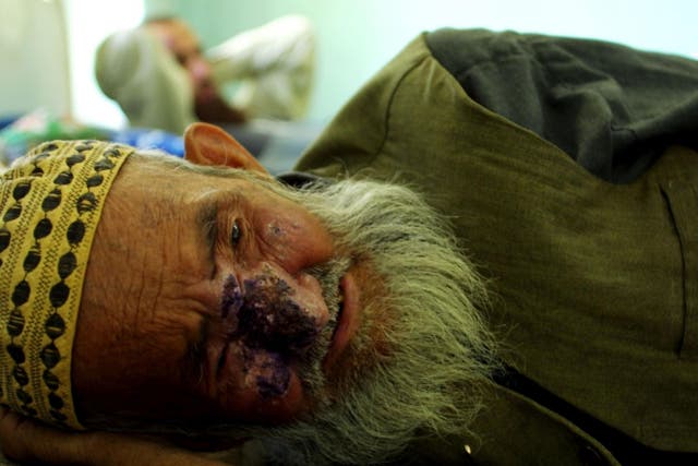 A man suffering from Cutaneous Leishmaniasis