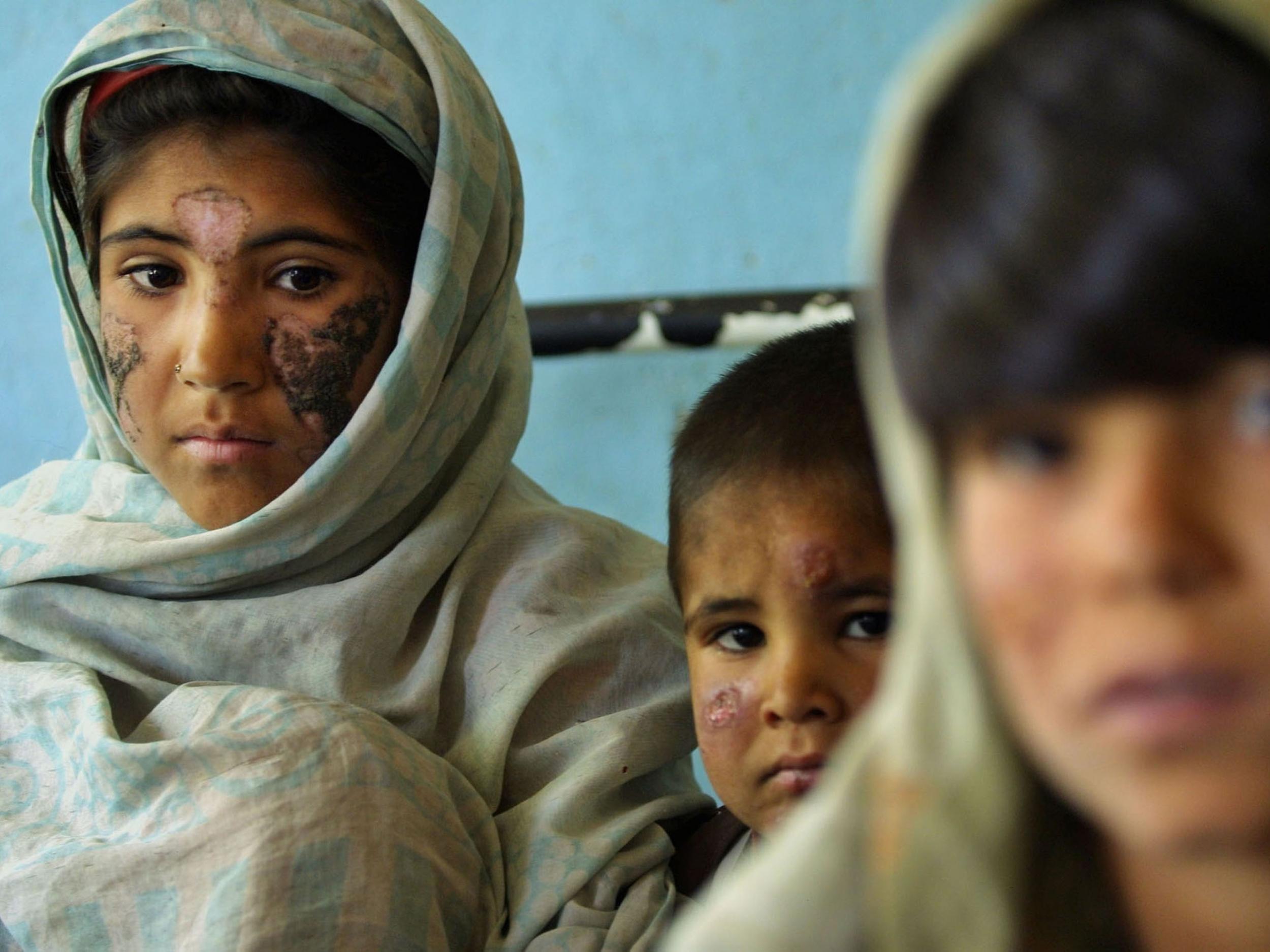Children suffering from Cutaneous Leishmaniasis, a disfiguring and disabling skin disease (Getty Images )