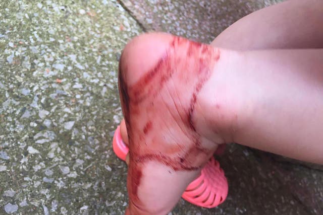 Pictures showed Esmé Connor with cuts and blood on her right foot after she wore the Next jelly sandals for 30 minutes