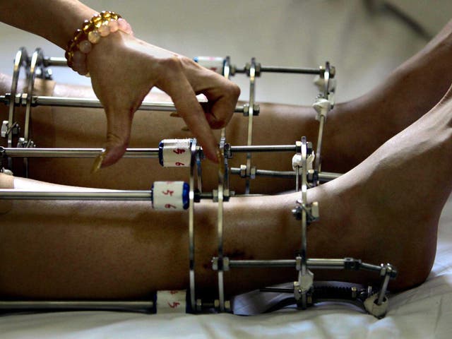 People are paying to have their legs broken by cosmetic surgeons. Here ...