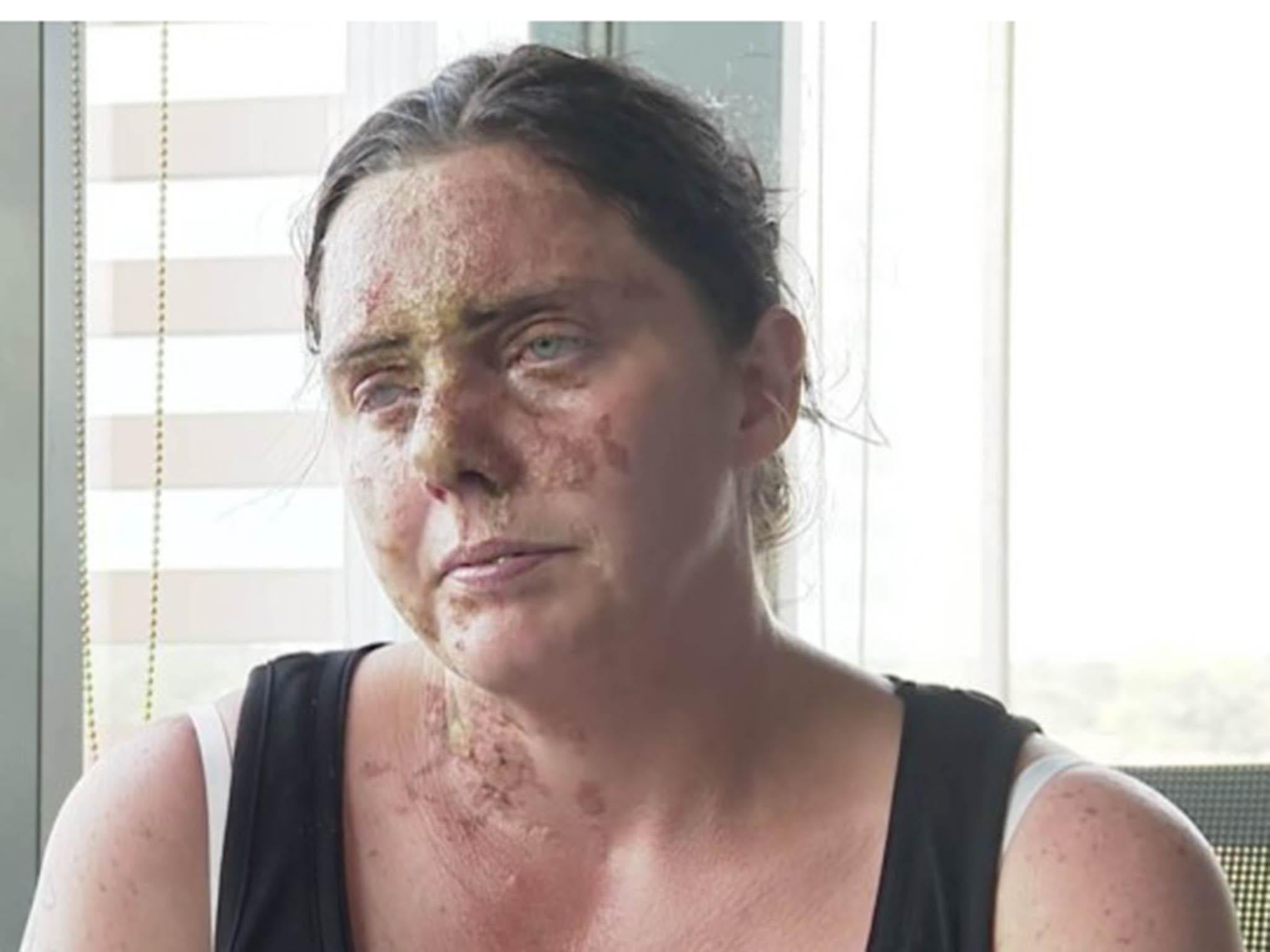 Carla Whitlock, 37, who was the victim of an acid attack outside the Turtle Bay Caribbean bar and restaurant in Guildhall Square, Southampton