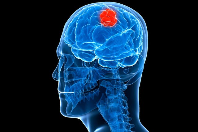 The Swedish study looked at socioeconomic factors relating to brain tumours
