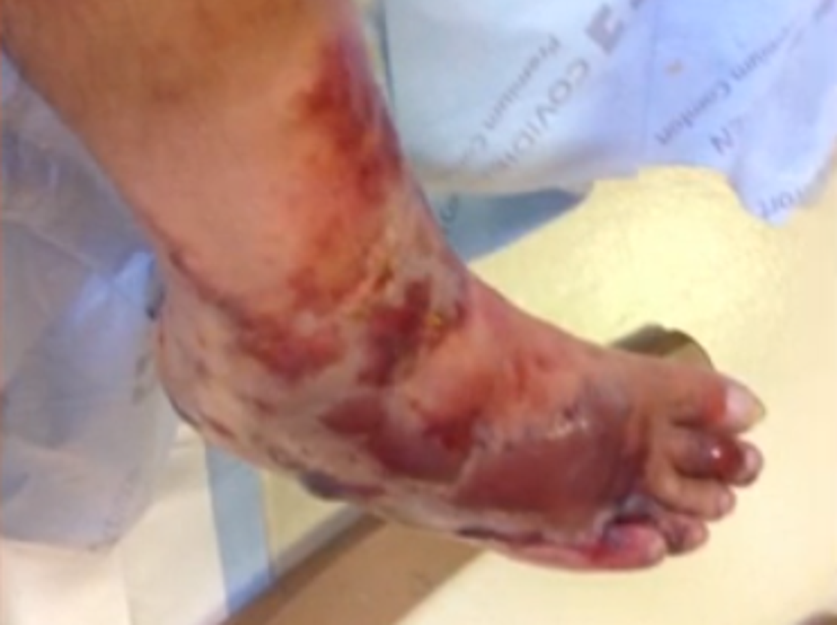 Mom Eats Fish, Loses Limbs to Flesh-Eating Bacteria