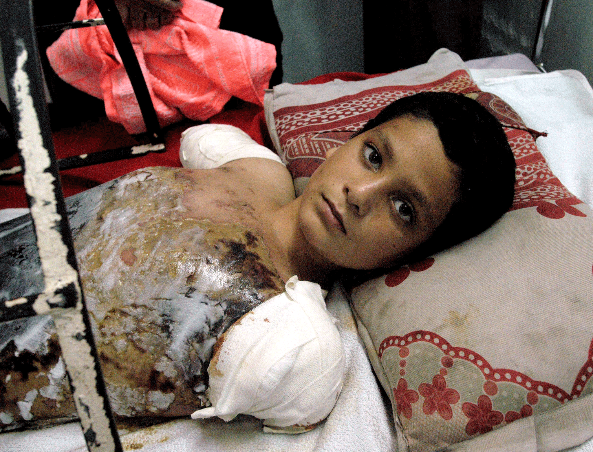Ali Abbas, aged 12, in an Iraqi hospital after a US airstrike