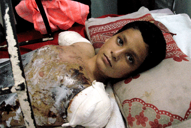 Ali Abbas, aged 12, in an Iraqi hospital after a US airstrike