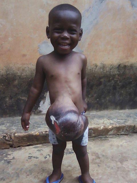 Ethan has a condition called Exomphalos which means his organs are outside his abdomen