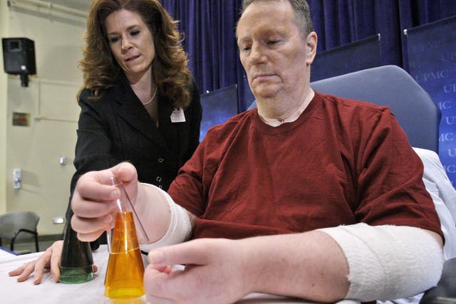Jeff Kepner was the first American to receive a double hand transplant. 