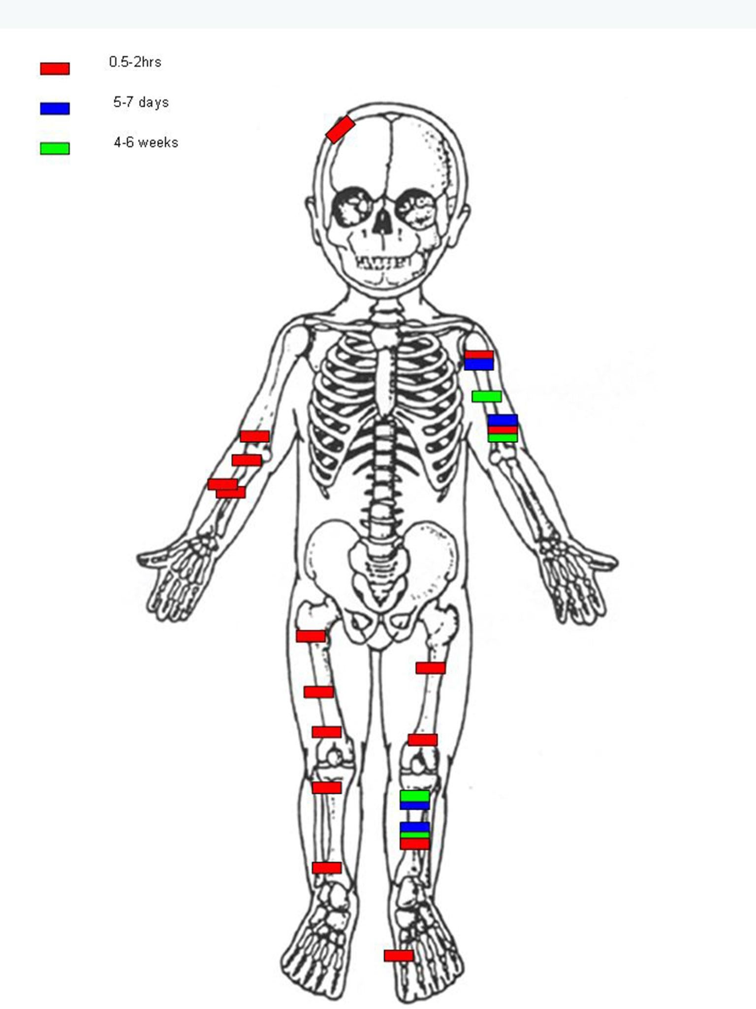 An illustration showing the extent of Noah's injuries
