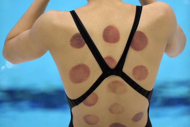 Chinese swimmer Wang Qun is seen with cupping marks during a training session at the 2008 Beijing Olympics