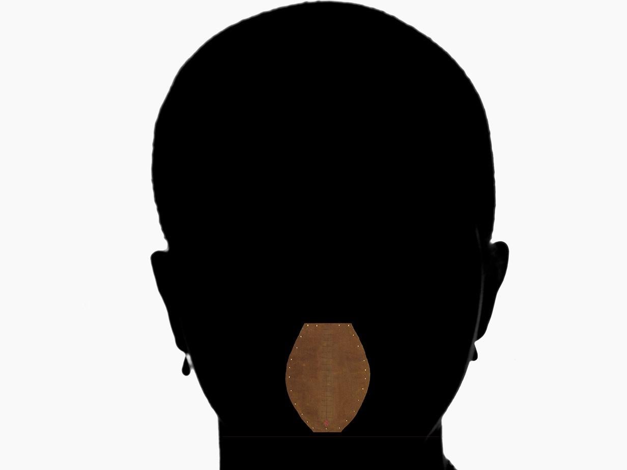 Type 3 FGM, or infibulation, involves the complete cutting away of the clitoris and sewing up the vulva