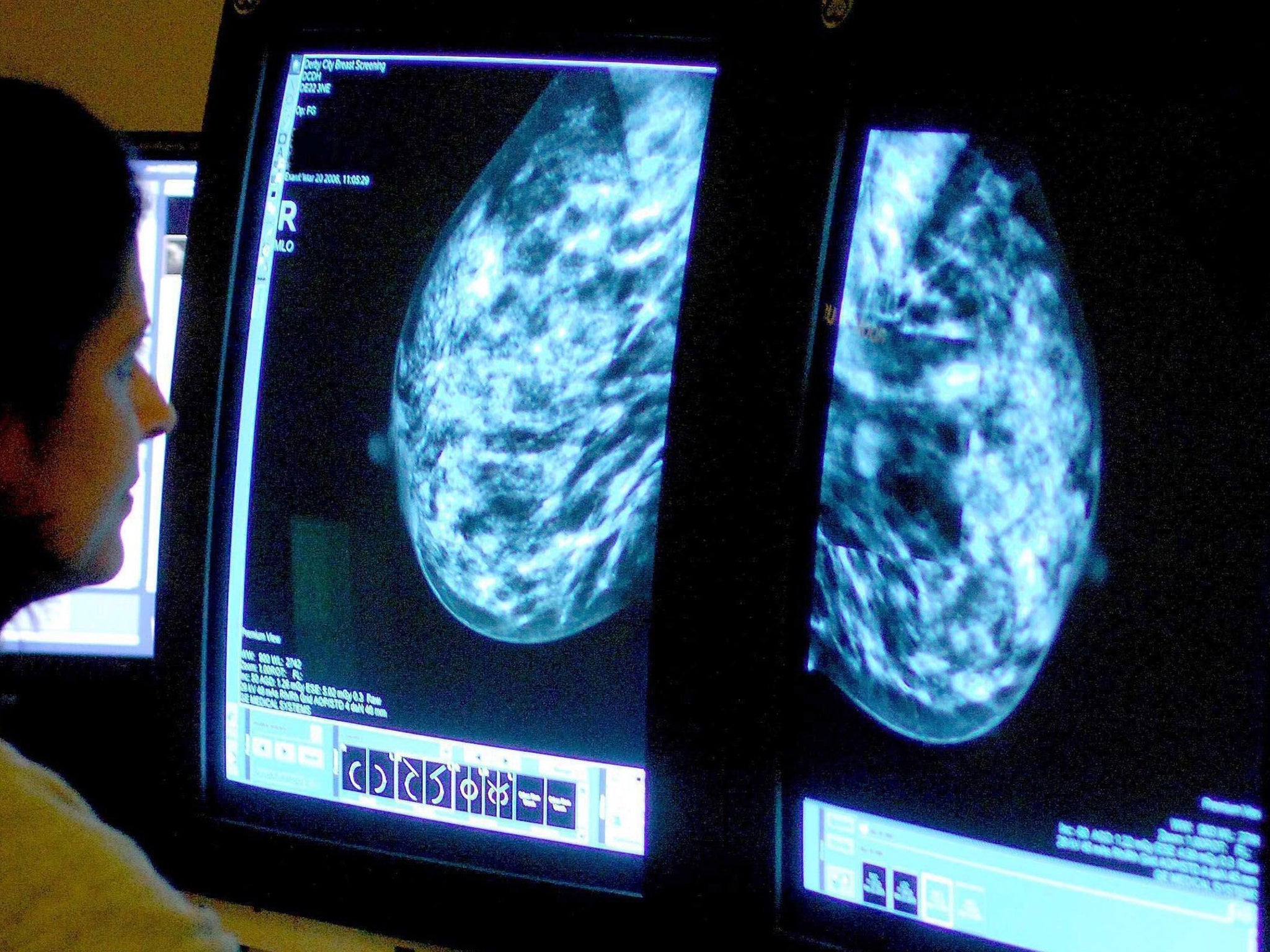 Scientists monitored more than 62,000 women over a period of 20 years to see how their breast cancer risk was affected by what they ate