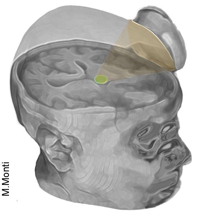 The ultrasound device fired a beam of sound into the brain to stimulate a specific area