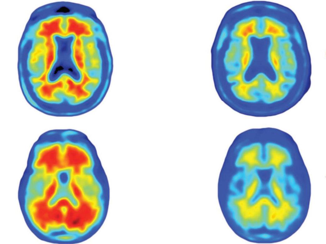 The brains of Alzheimer's patients, showing how different doses of the drug reduced the number of amyloid plaques, in red, over a year