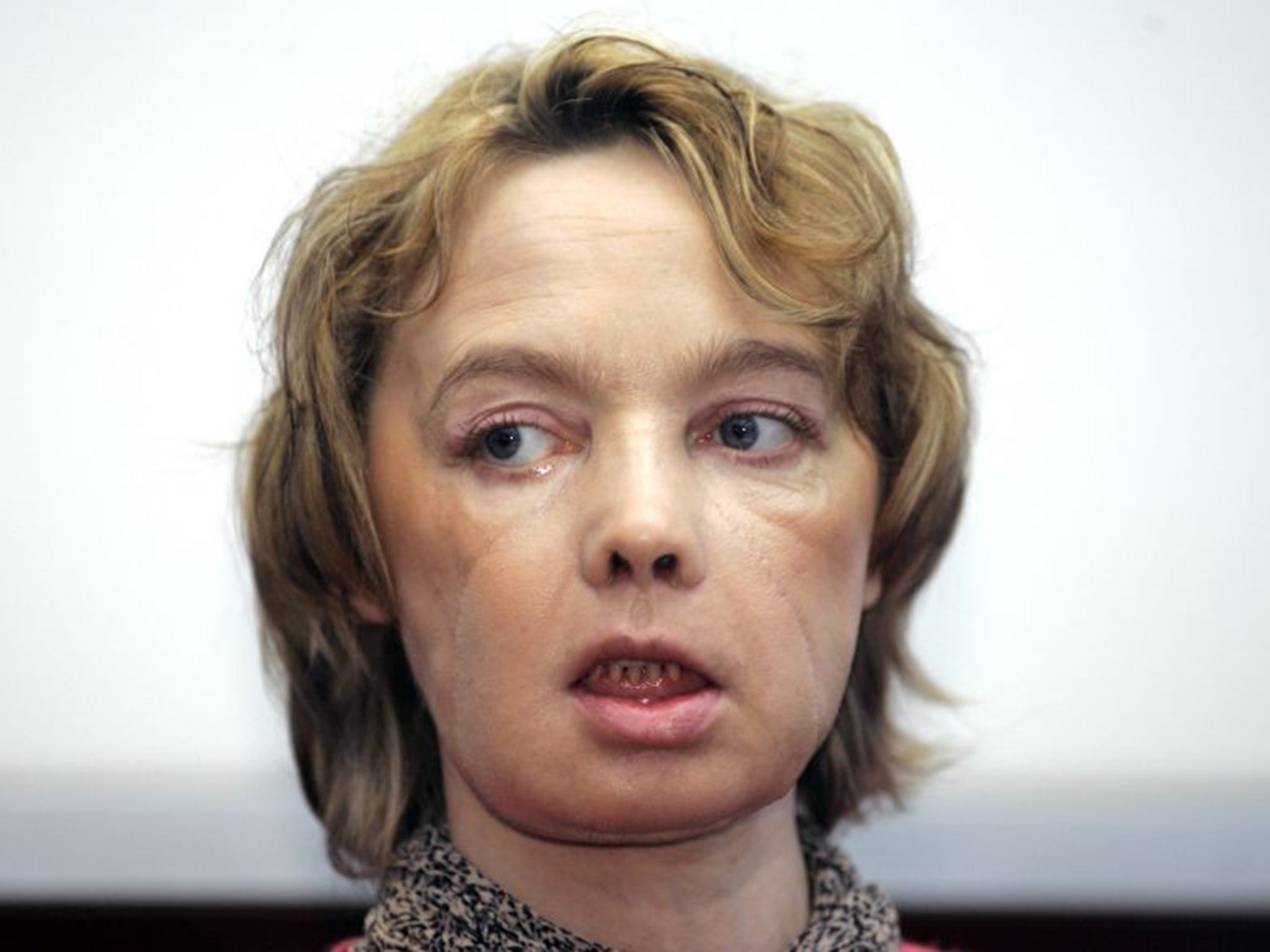 Isabelle Dinoire received her new face in 2005 after being mauled by a dog