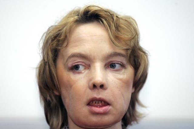 Isabelle Dinoire received her new face in 2005 after being mauled by a dog