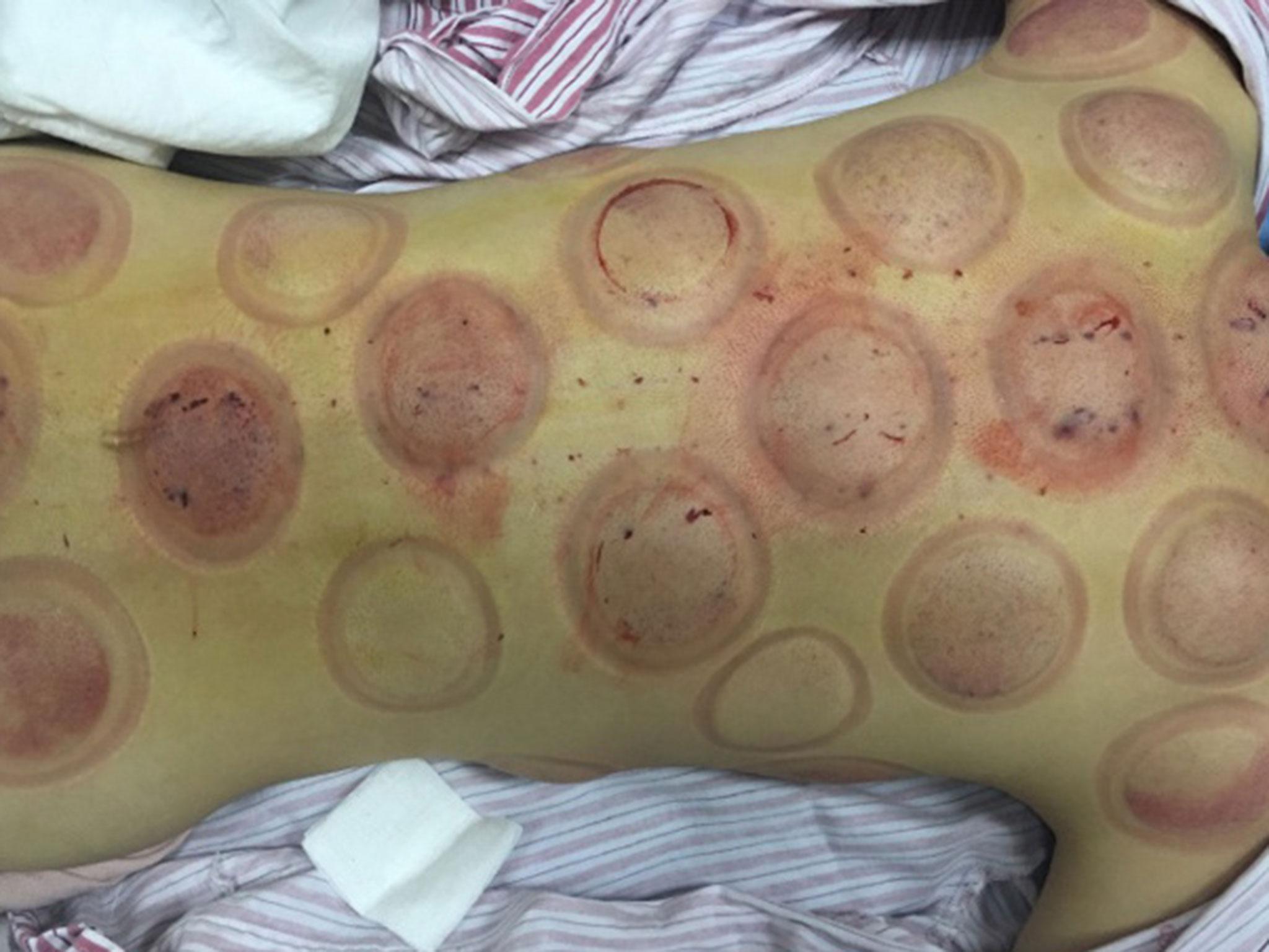 Pictures from Xu Ting's Sina Weibo social media account show the aftermath of a cupping session