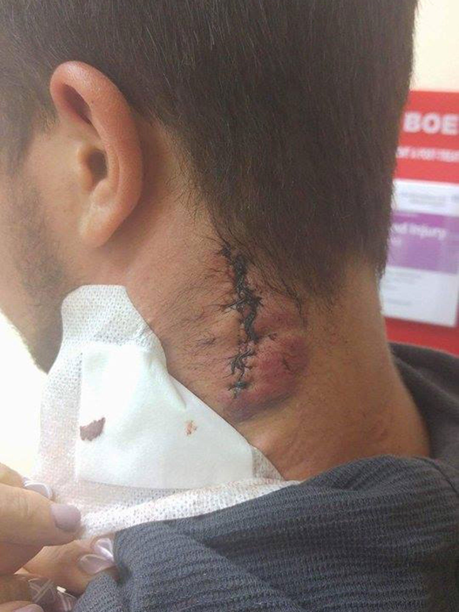 Bartosz Milewski needed 13 stitches after being stabbed in the neck (Bartosz Milewski )